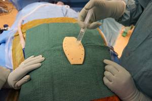 Sternum en céramique d’alumine poreuse implanté pour la 1ère fois le 19 mars 2015 au CHU de Limoges par le Dr François Bertin